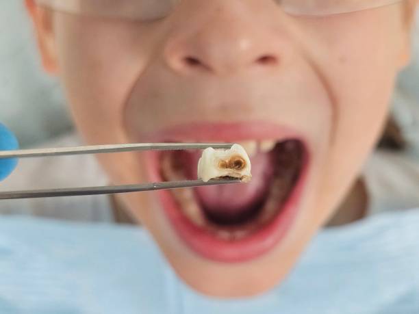 Best Chipped Tooth Repair Near Me  in Makaha, HI